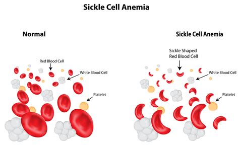 Sickle Cell Anemia - Net Health Book