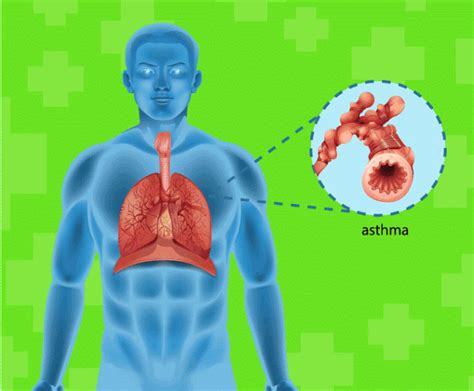 #AsthmaSymptoms !! #Asthma signs and symptoms include: • Shortness of breath • Chest tightness ...