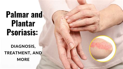 Palmar and Plantar Psoriasis: Diagnosis, Treatment, and More – Hanna Sillitoe