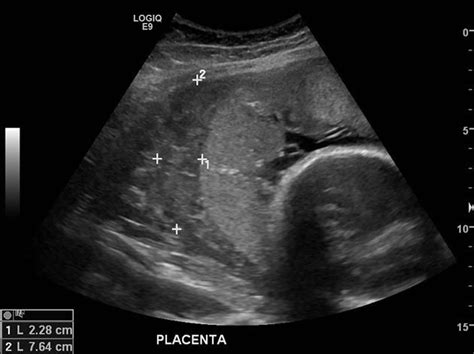 Placental Abruption - Causes, Signs, Symptoms, Treatment