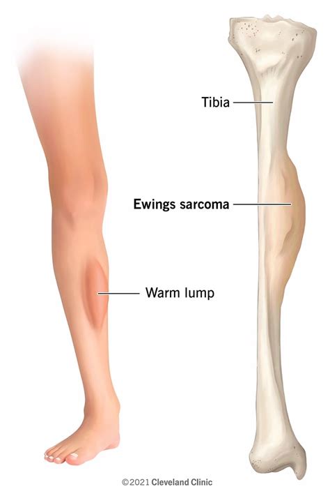 Ewing's Sarcoma: What Is It, Symptoms, Treatment & Outlook