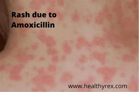 Can Amoxicillin Raise Your Blood Sugar