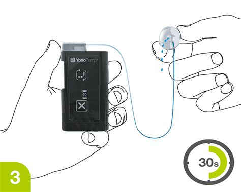 YpsoPump insulin pump - mylife Diabetescare - Canada