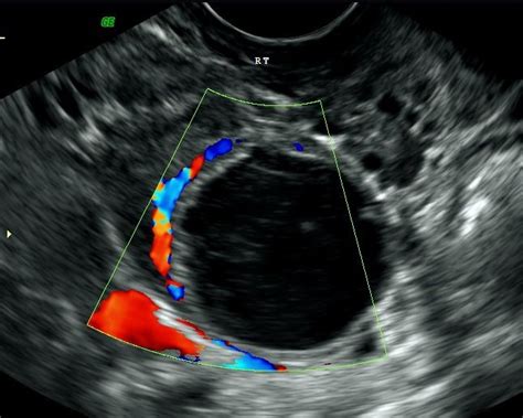 Pelvic Ultrasound Scans for Women in London - Ultrasound Services