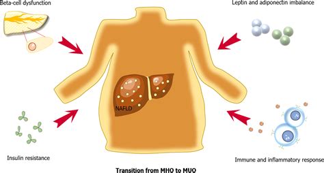 Metabolically healthy obesity: Is it really healthy for type 2 diabetes mellitus?