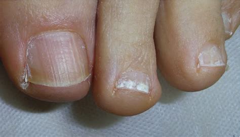 Onychorrhexis on the toenail and superficial white ony­ chomycosis on ...