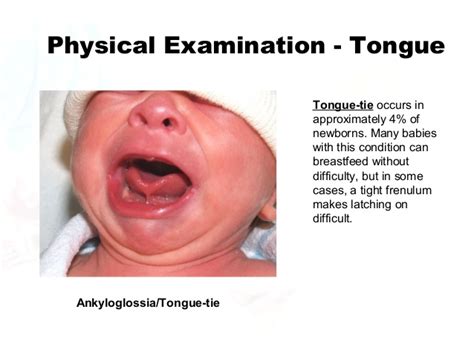 Dentist East Berlin PA: Example of a Tongue-Tie in an Infant