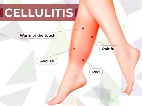 11 Best Home Remedies To Treat Cellulitis - Boldsky.com