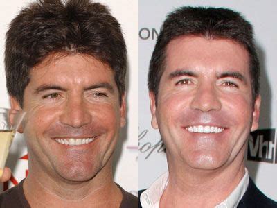 Has Simon Cowell Got False Teeth - Teeth Poster