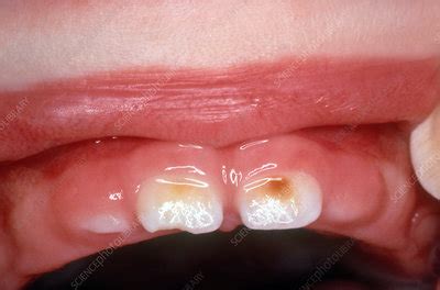 Enamel Hypoplasia - Stock Image - C039/3019 - Science Photo Library