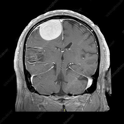 Large Meningioma on MRI - Stock Image - C027/1687 - Science Photo Library