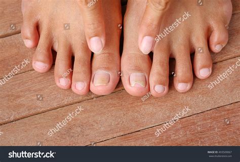 Point To Damaged Toenail, Broken Nail Stock Photo 493509067 : Shutterstock