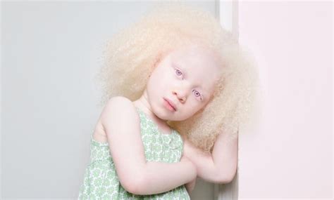 Albinism Symptoms
