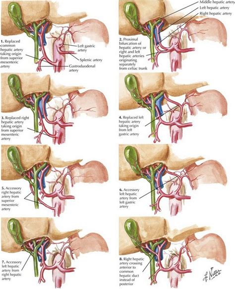 Laparoscopic and Open Cholecystectomy | Basicmedical Key