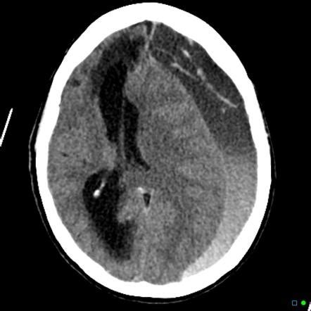 Viewing playlist: cns | Radiopaedia.org