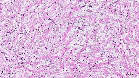 Neurofibroma - MyPathologyReport.ca