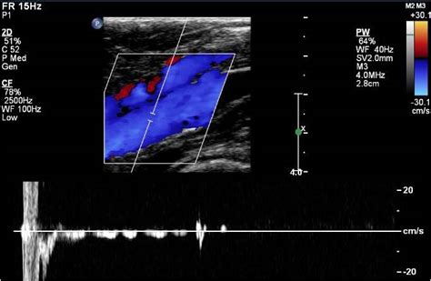 Venous Malformation Ultrasound