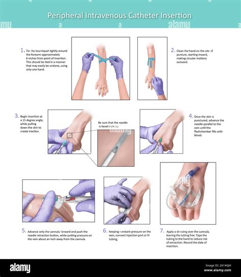 Illustration depicting the proper placement of a peripheral intravenous ...