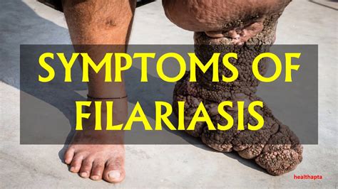 SYMPTOMS OF FILARIASIS - YouTube