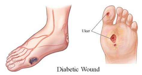 Healing Diabetic Wounds with HOCl – HOCl Health Care