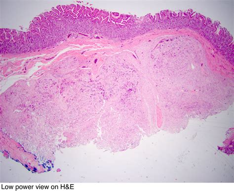 Pathology Outlines - Gangliocytic paraganglioma