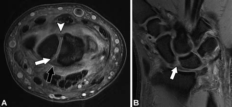 Scapholunate Ligament Mri