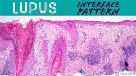 Lupus Erythematosus - Interface Dermatitis: Inflammatory Dermpath Basics for Dermatology ...