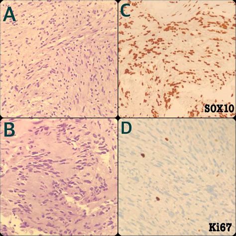 Schwannoma tumor cells are mostly spindled and arranged in short ...