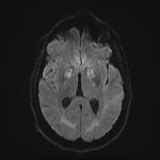 File:Cerebellar, hippocampal, and basal nuclei transient edema with ...