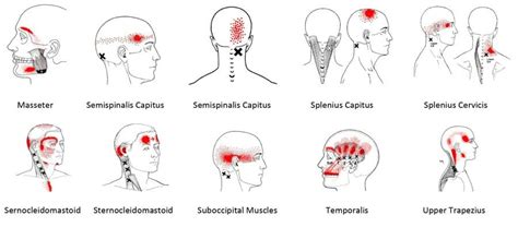 One Sided Trapezius Headache - Headache