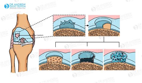 Cartilage Regeneration Singapore: Benefits, Risks & Recovery