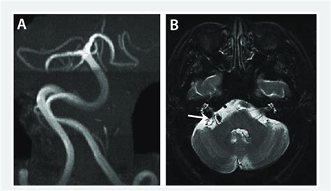 Vertebrobasilar dolichoectasia in Fabry disease. A, Magnetic resonance ...