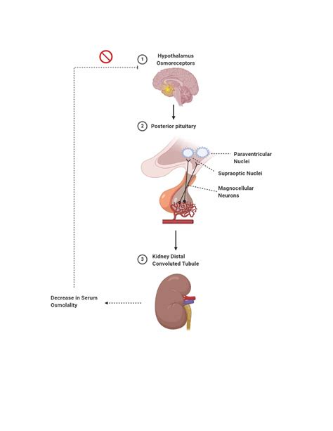 Cureus | Diabetes Insipidus: Pathogenesis, Diagnosis, and Clinical Management