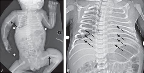 Osteogenesis Imperfecta Type 1 Causes Symptoms