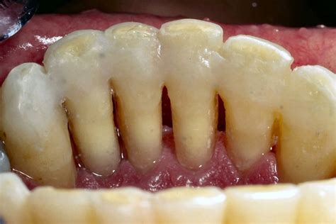 Samuel V. Rowe, DMD, P.A. | Periodontal Splinting (Weak Teeth) in Fort ...