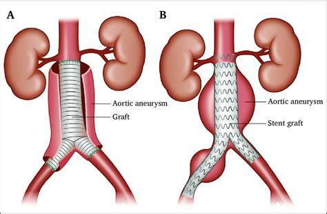 Open Abdominal Aortic Aneurysm And Endovascular Aneurysm Repair Surgery ...