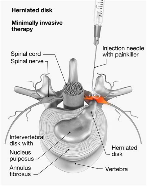 Nerve Root Block | Back Pain | Transforaminal Epidural | Bristol, Bath ...