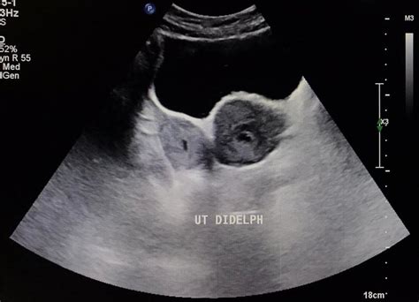 Ultrasound showing uterus didelphys postnatally on day 7 | Download Scientific Diagram