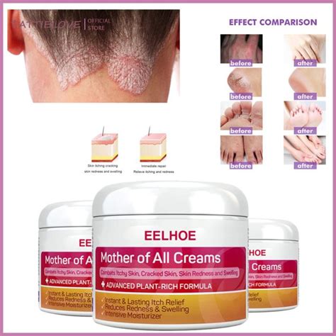 EELHOE Psoriasis Cream Psoriasis Treatment Cream Psoriasis Eczema Cream ...