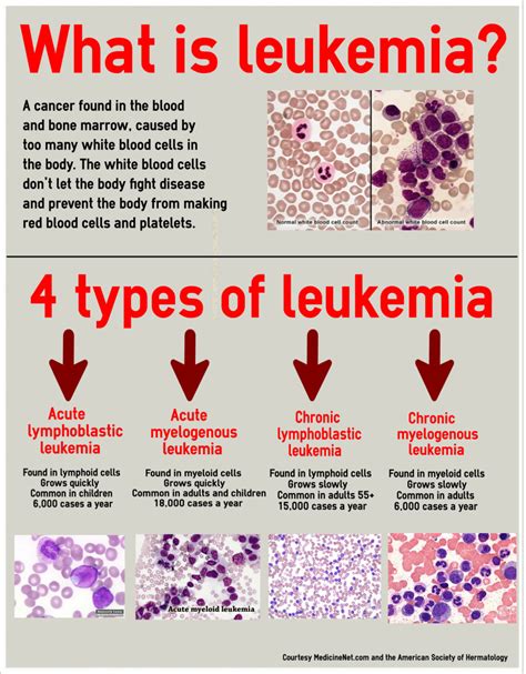 About Leukemia | Things Health