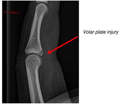 Avulsion Fracture Finger