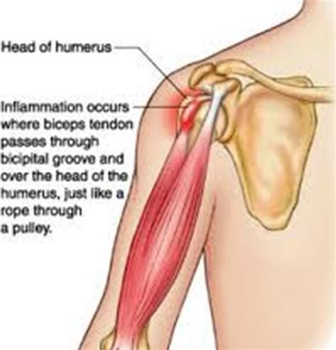 Biceps Tendinitis | Brisbane Knee and Shoulder Clinic | Dr MacgroartyBrisbane Knee and Shoulder ...