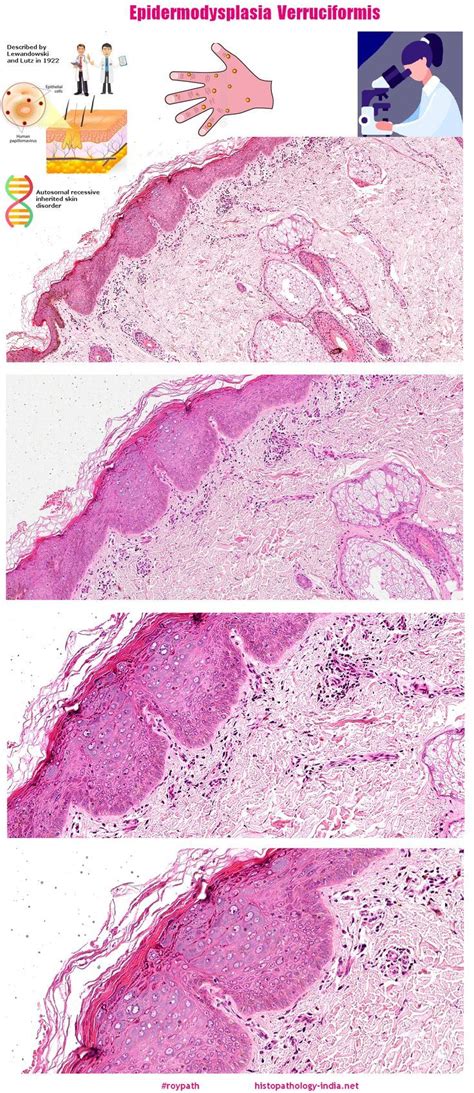 Pathology of Epidermodysplasia Verruciformis