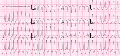 Dr. Smith's ECG Blog: Regular Wide Complex Tachycardia. What is the Diagnosis?