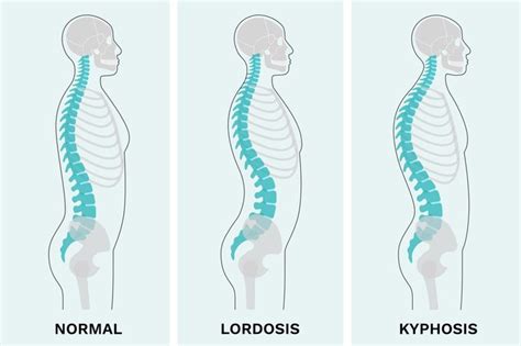 Kyphosis vs. Lordosis: What's the Difference? | The Healthy