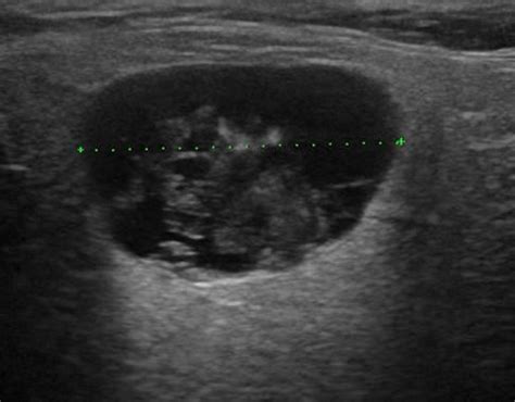 Head and Neck | 4.3 Salivary glands : Case 4.3.4 Warthin's tumors | Ultrasound Cases