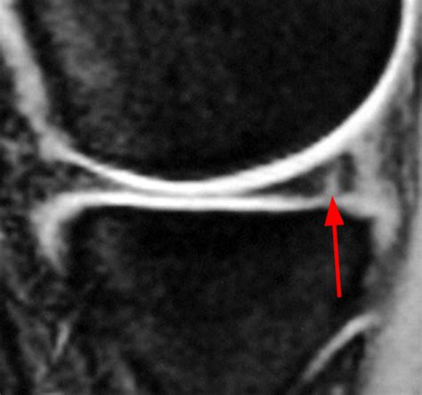 Medial Meniscus Tear Mri