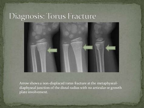 Torus Fracture