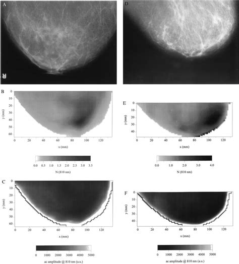 X-ray mammograms (A, craniocaudal; D, mediolateral) and optical ...