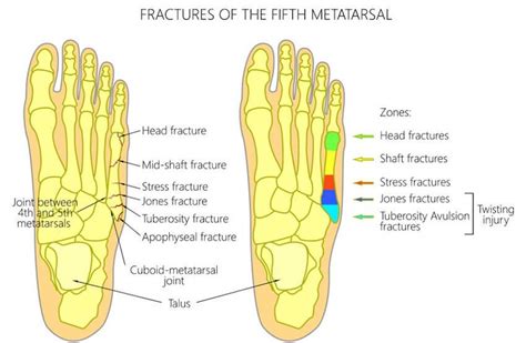 Metatarsal Stress Fracture